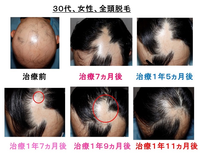 円形脱毛症　病院